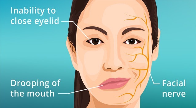 Effective Bell’s Palsy treatment in Dubai by expert neurologists